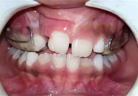 Image result for Maxillary Protraction