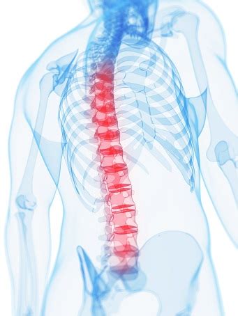 Afbeeldingsresultaten voor T12 Compression Fracture Recovery Time