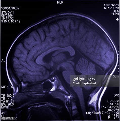 Image result for Prefrontal Cortex Brain Scan