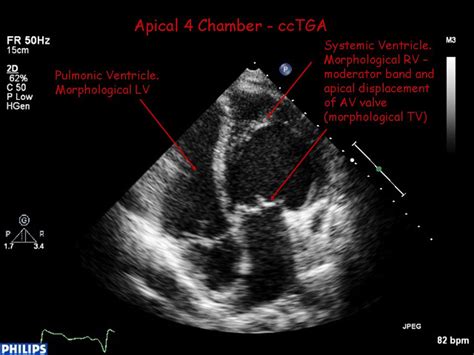 Afbeeldingsresultaten voor Corrected Transposition