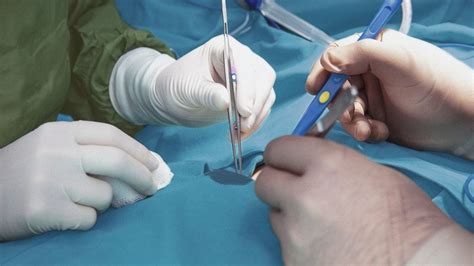 Image result for Types of Colostomy