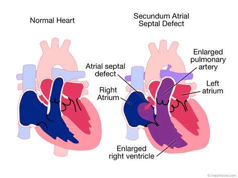 Toradh íomhá ar Atrial Septal Defect Classification