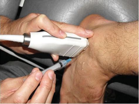 Image result for Subtalar Joint Injection vs Sinus Tarsi