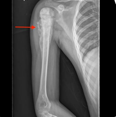 Image result for Codman Triangle Mandible Radiograph