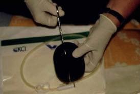 Transporting Wound Vac Walker に対する画像結果