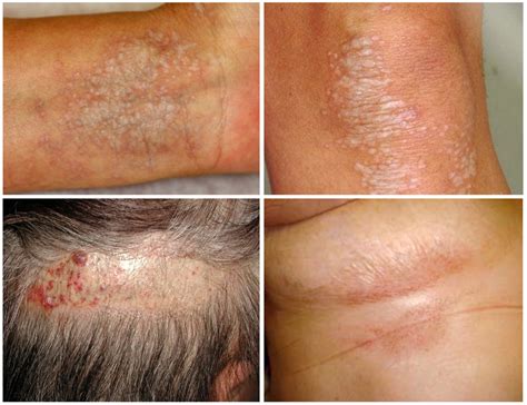 Lichen Toompje に対する画像結果