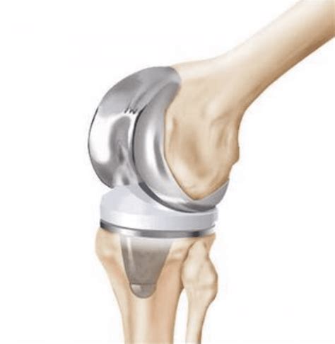 Image result for PF Joint-Replacement