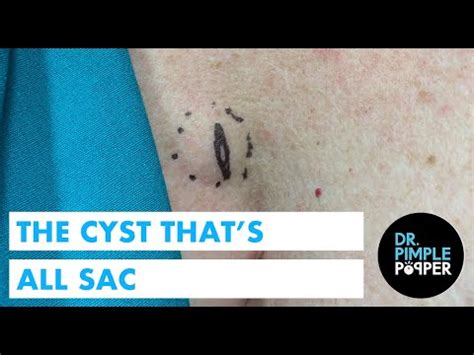 Image result for Exploding Cyst Sac