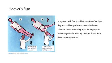 Image result for Leg. Sign Functional Movement Disorder