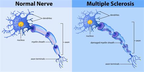 Image result for Multiple Sclerosis Graphics