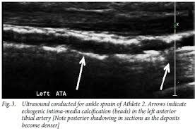 Pressure Gradient Segmental Pressure Lower Extremity に対する画像結果