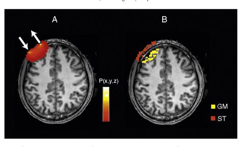 Image result for MRI Scanner Prefrontal Cortex