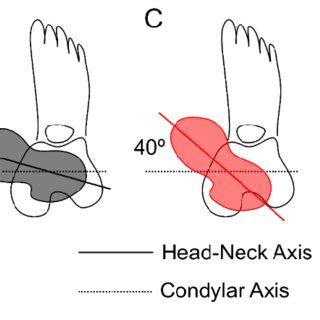 Image result for Femoral Retroversion Angle