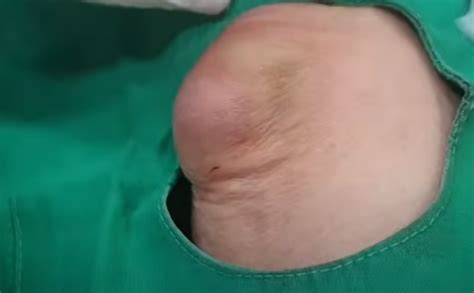 Image result for Sebaceous Cyst Pimple