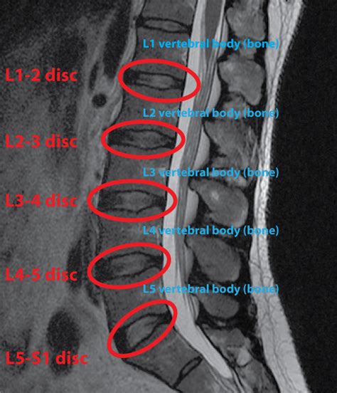 Abnormal MRI Lumbar Spine に対する画像結果