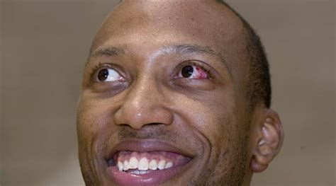 Image result for Eye Pops Out of Socket