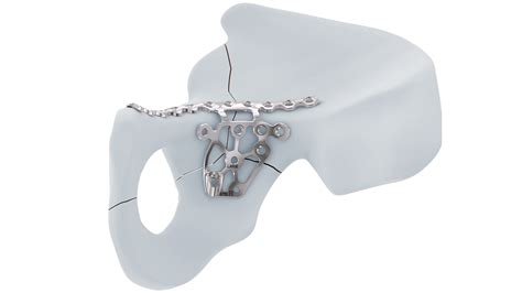 Toradh íomhá ar Curve Spring Plate