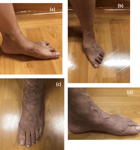 Toradh íomhá ar Navicular Bony Prominence