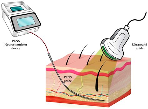 Transcutaneous Electrical Stimulation-এর ছবি ফলাফল