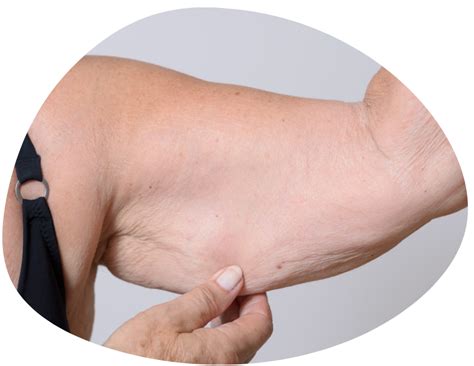 Image result for Loose Skin Condition