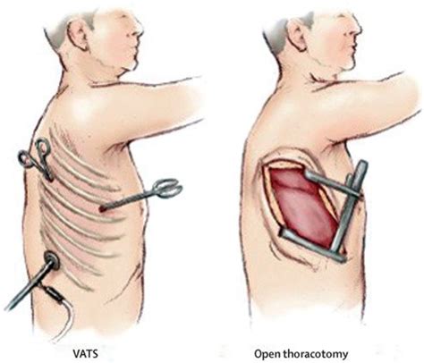 Image result for Thoracotomy Procedure