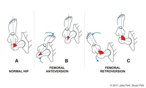 Toradh íomhá ar Femoral Anteversion vs Retroversion