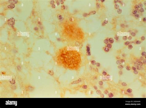 CJD Brain に対する画像結果