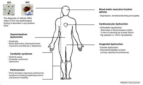 Toradh íomhá ar Multiple System Atrophy