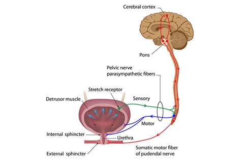 Toradh íomhá ar Neurogenic Areflexic Bladder