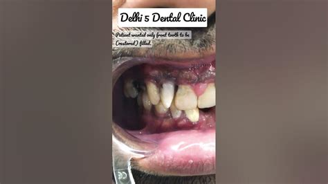Image result for Broken Decayed Tooth