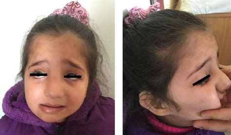 Image result for Dysmorphic ASD