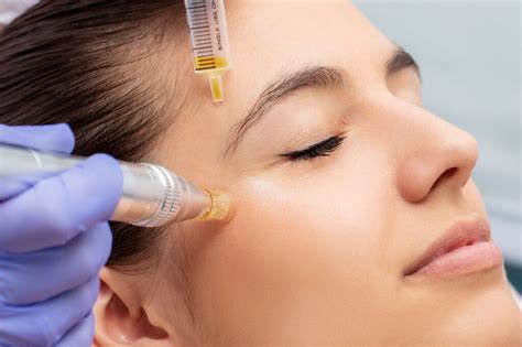 Image result for Needling Face Treatment