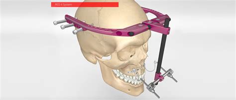 تصویر کا نتیجہ برائے Spring Loaded Distractor