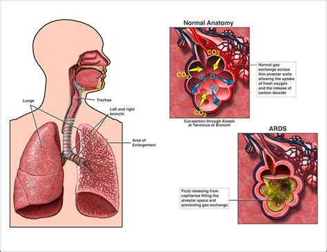 Image result for Prone Positioning in Itu
