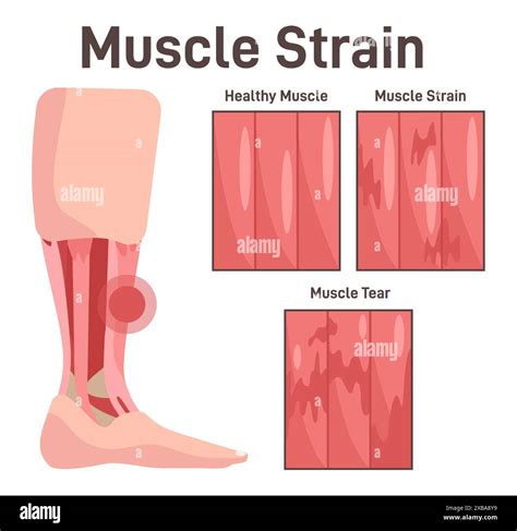Image result for Strained Thigh Muscle