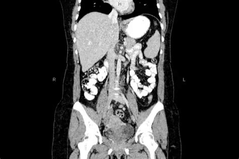 Image result for Ulcerative Colitis CT Scan