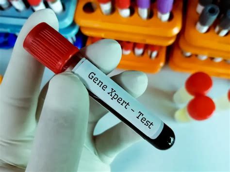 Toradh íomhá ar GeneXpert TB Diagnosis