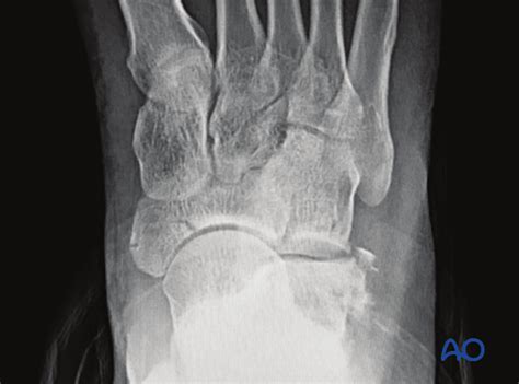 Toradh íomhá ar Navicular Fracture Not Healing