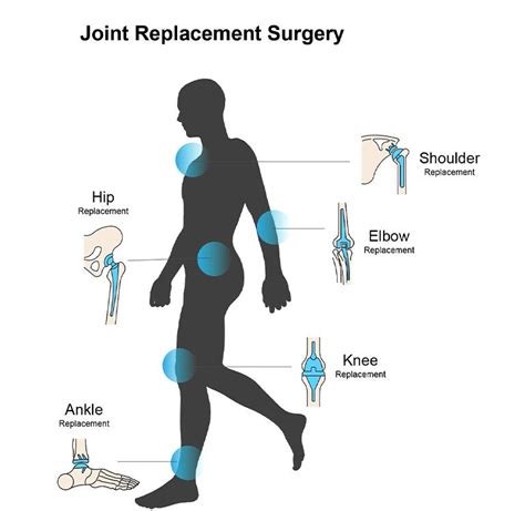 Image result for PF Joint-Replacement