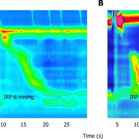 Image result for Normal Manometry