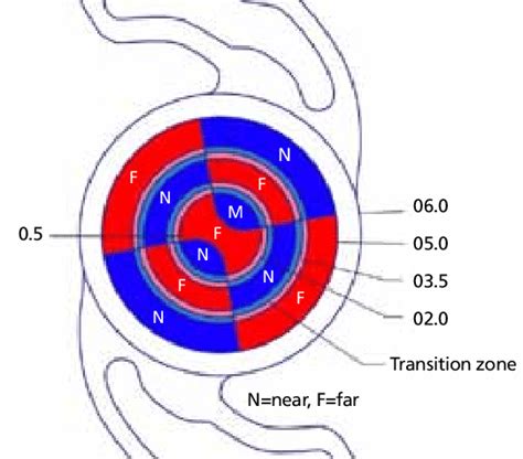 Image result for Refractive IOL Multifocal Optics