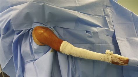 Bicep Tenodesis Physical Therapy に対する画像結果