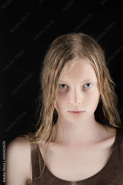 Light Blue Eyes Albinism に対する画像結果