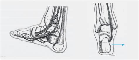 Image result for Pes Planovalgus