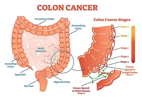 Colon Cancer Classification に対する画像結果