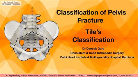 Afbeeldingsresultaten voor Pelvic Fracture Types