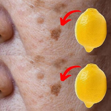 Image result for How to Permanently Remove Age Spots