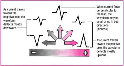 Image result for Positive and Negative Deflection ECG