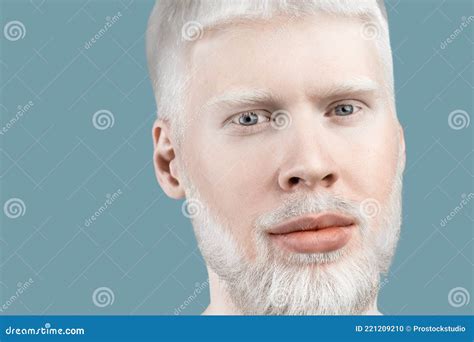 Light Blue Eyes Albinism に対する画像結果