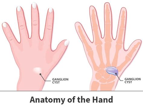 Toradh íomhá ar What Causes Ganglion Cyst